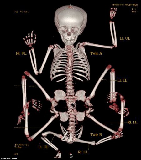 reincarnation-of-hindu-god-vishnu-xray-skeleton